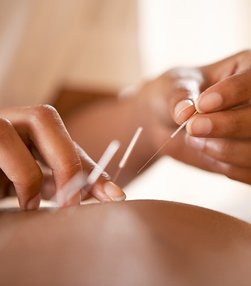 Acupuncture