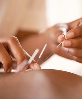 Acupuncture