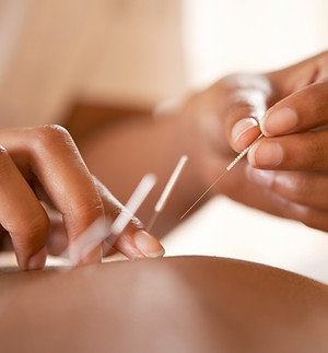 Akupunktur