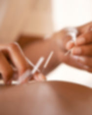 Acupuncture