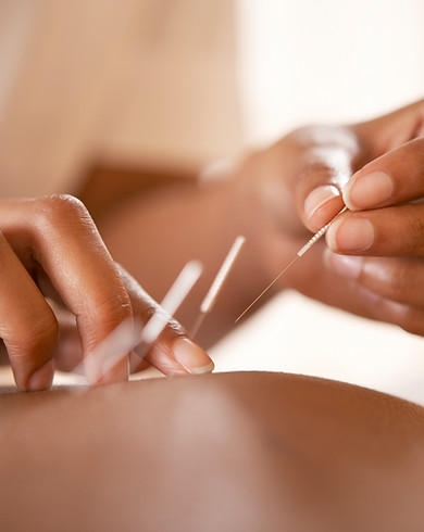 Acupuncture