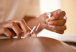 Acupuncture Treatment