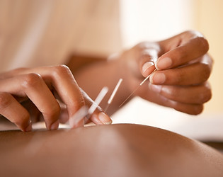 Acupuncture