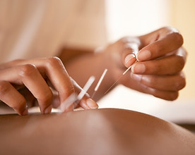 Acupuncture