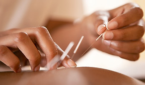 Acupuncture