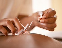 acupuntura