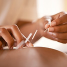 Akupunktur im Raum für Wachstum TCM und Naturheilpraxis in Zofingen Gesundheit