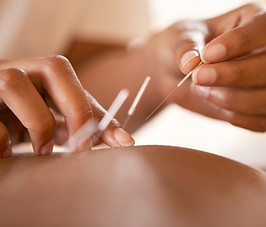 Acupuncture