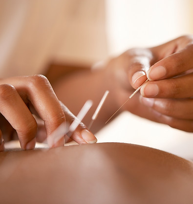 Akupunktur