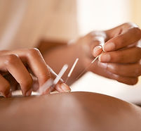 Acupuncture