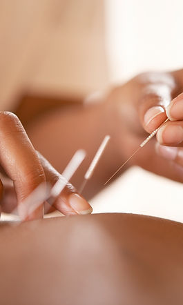 Acupuncture Therapy Session