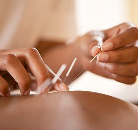 Acupuncture