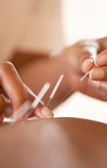 acupunctuur