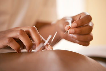 Acupuncture