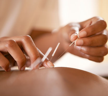 Acupuncture Therapy Session