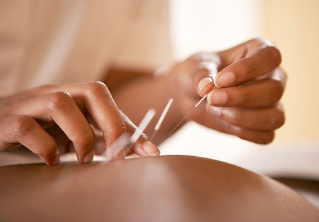 Acupuncture Adelaide