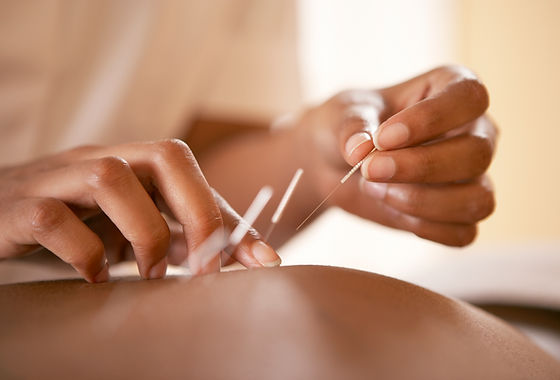 Acupuncture