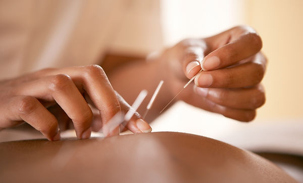 Acupuncture