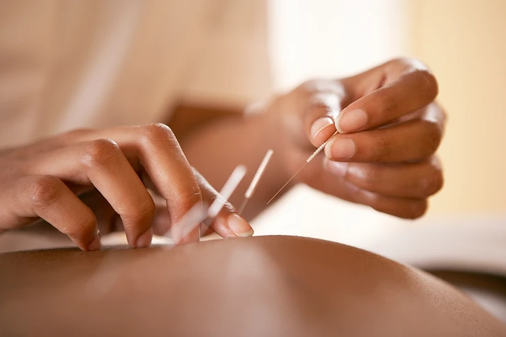 acupuncturist applying acupuncture needles to patient