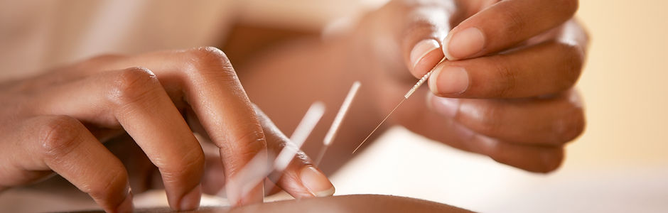 Acupuncture