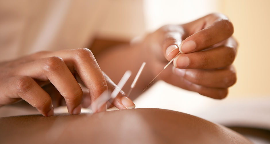Acupuncture