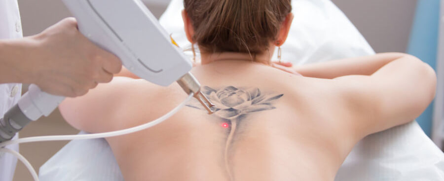 Eliminación tatuajes