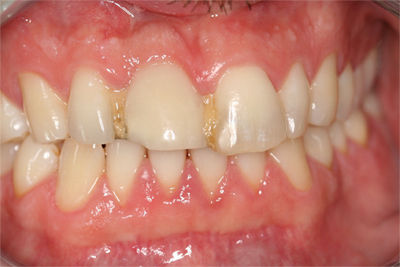 Patient 4 Before