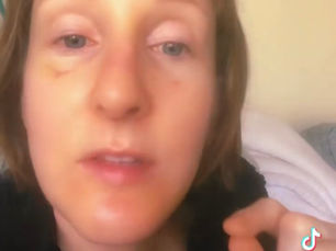 Lymphatic swelling and venous congestion after facelift