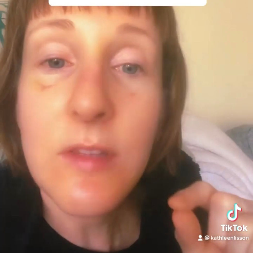 Lymphatic swelling and venous congestion after facelift
