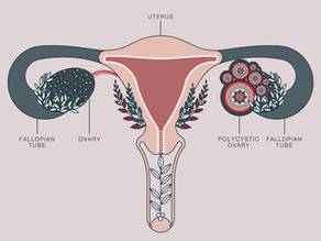 Why I have PCOS