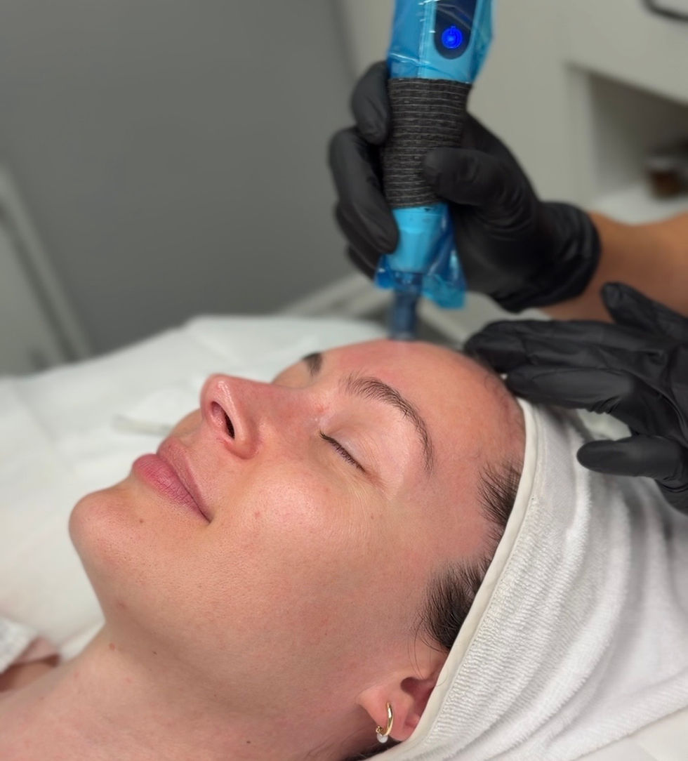Microneedling Infusion at Allure Beauty Bar in Burnaby