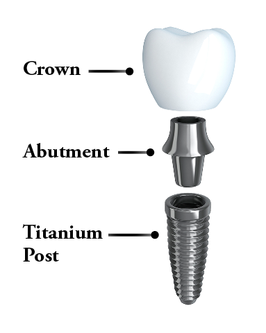 What the heck is an abutment?!