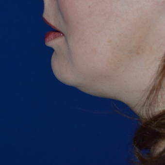 Lipodissolve-before-3755305-2842712.webp