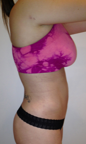 Lipodissolve-after-9173396-4191986.webp