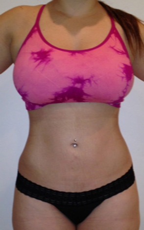 Lipodissolve-after-9173382-4191948.webp
