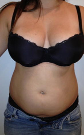 Lipodissolve-before-9173382-4191947.webp