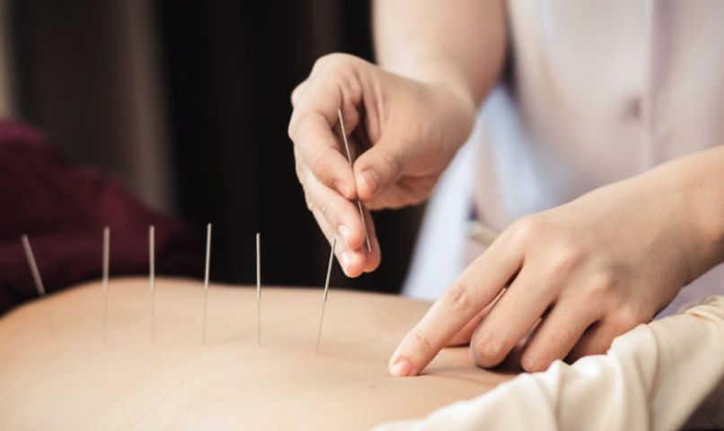 benefits-of-acupuncture-for-working-out-