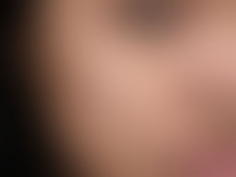 Close-up of a woman’s cheek showing natural skin texture, blemishes, and mild hyperpigmentation, used to illustrate real-life skin concerns addressed by glutathione IV therapy.