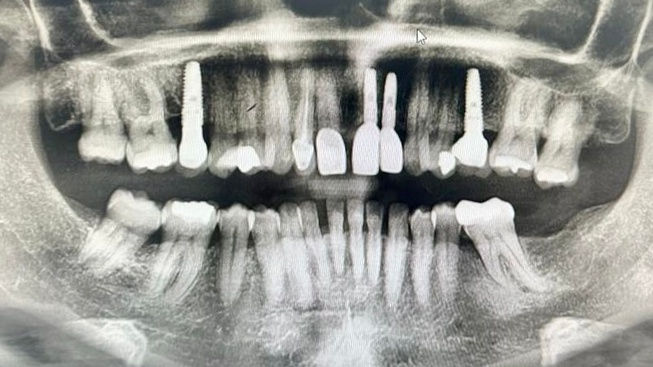 Post-operative panoramic dental radiograph showing four dental implants and restorations after treatment