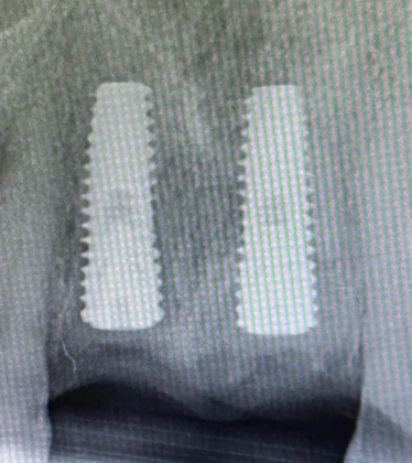 At four months post-placement, both implants show radiographic evidence of osseointegration with maintained crestal bone and favourable implant positioning, confirming readiness for the restorative phase.