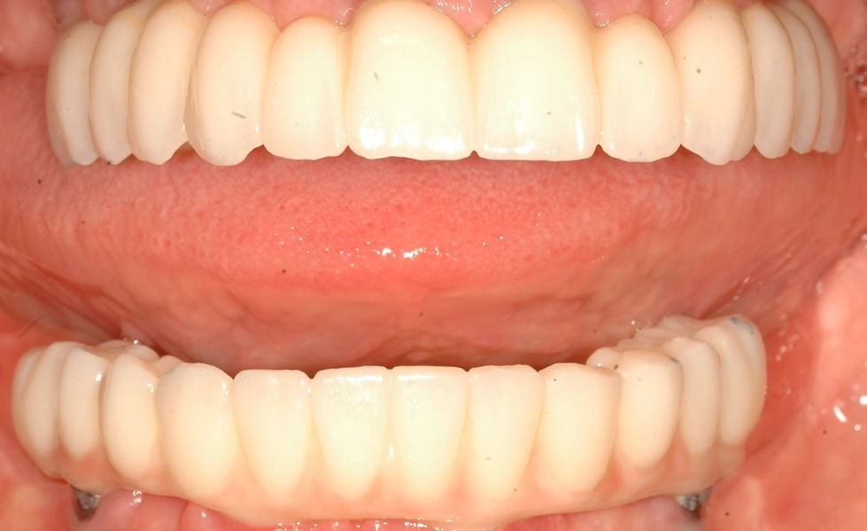 new smile upper porcelain :lower acrylic