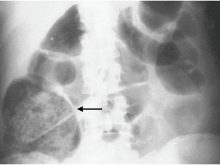 "fecal loading in the cecum"は論文5つ。でもメタ解析はできない。