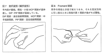 しびれについて執筆しました