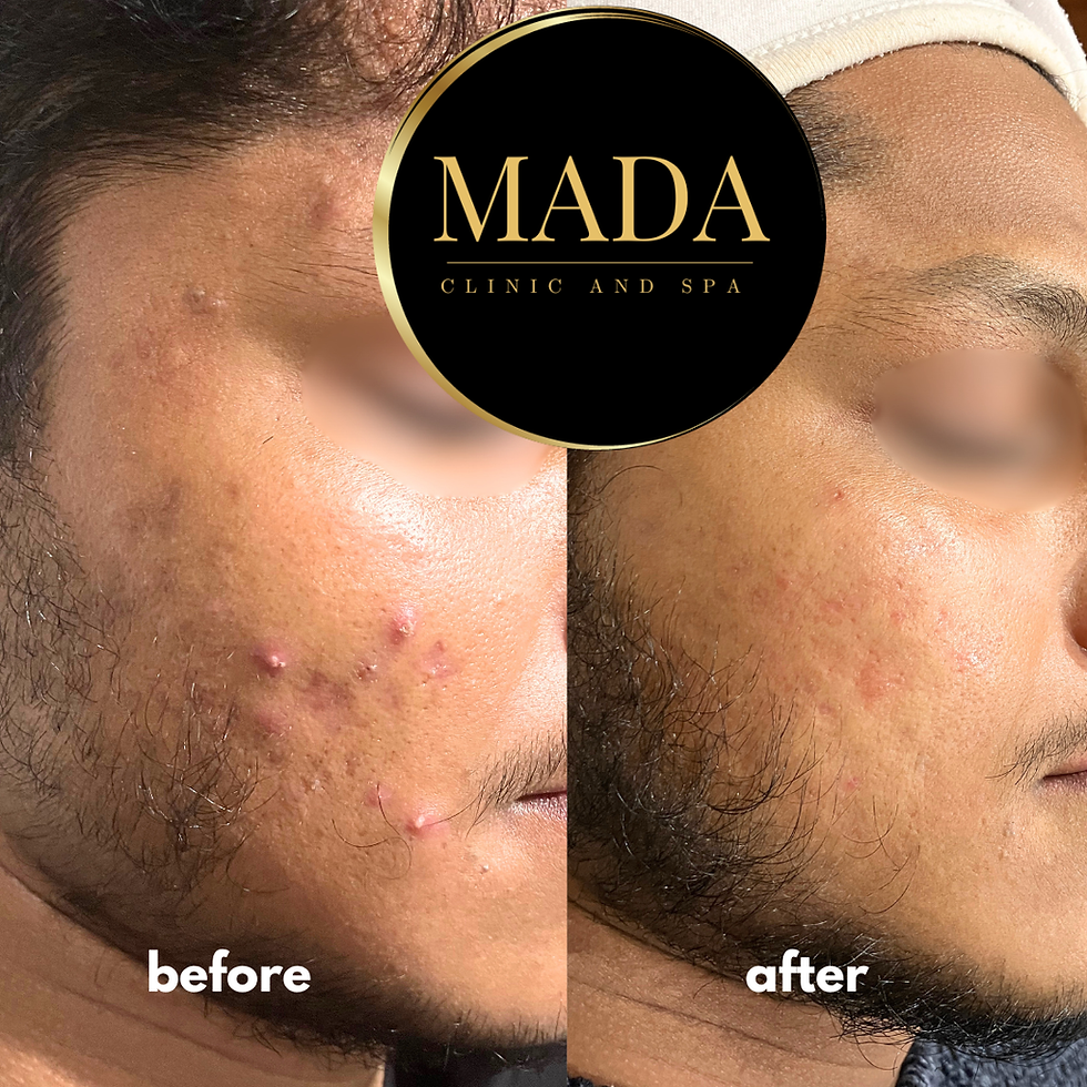 acne treatment in Dublin
