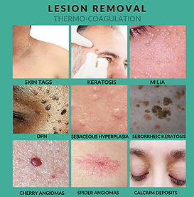 lesion removal revised flyer_edited.jpg