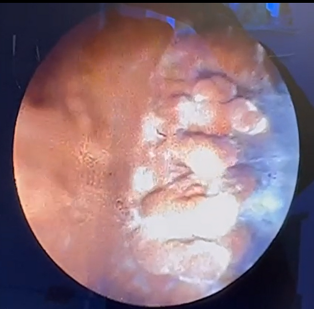 This is the ciliary body during a glaucoma treatment called endolaser or laser cyclophotocoagulation
