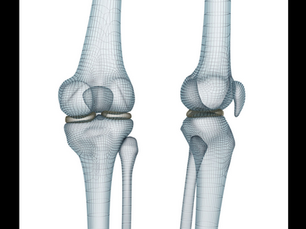 Recurrent subluxation of the patella