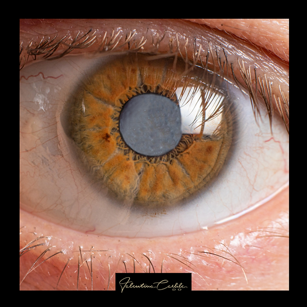 Cataract: what are the symptoms, how is the operation performed and what are the results?