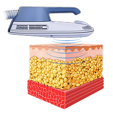 Em sculpt explications