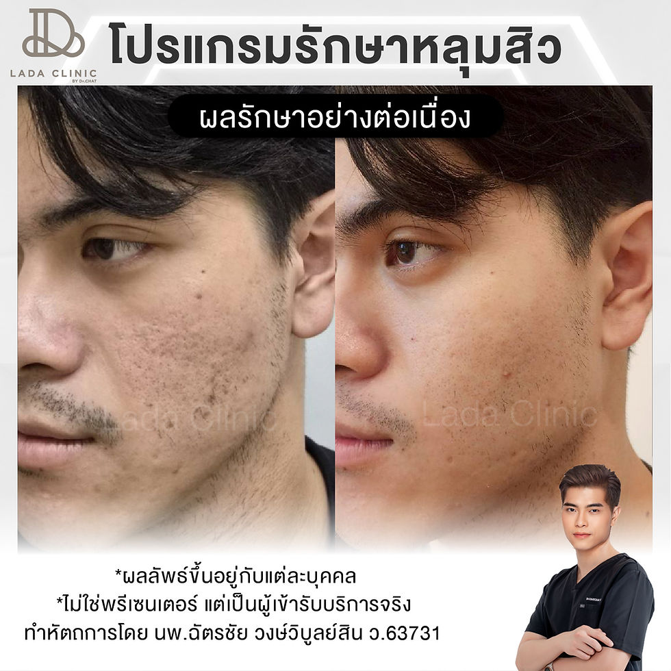 acne-scar-treatment-korat-01